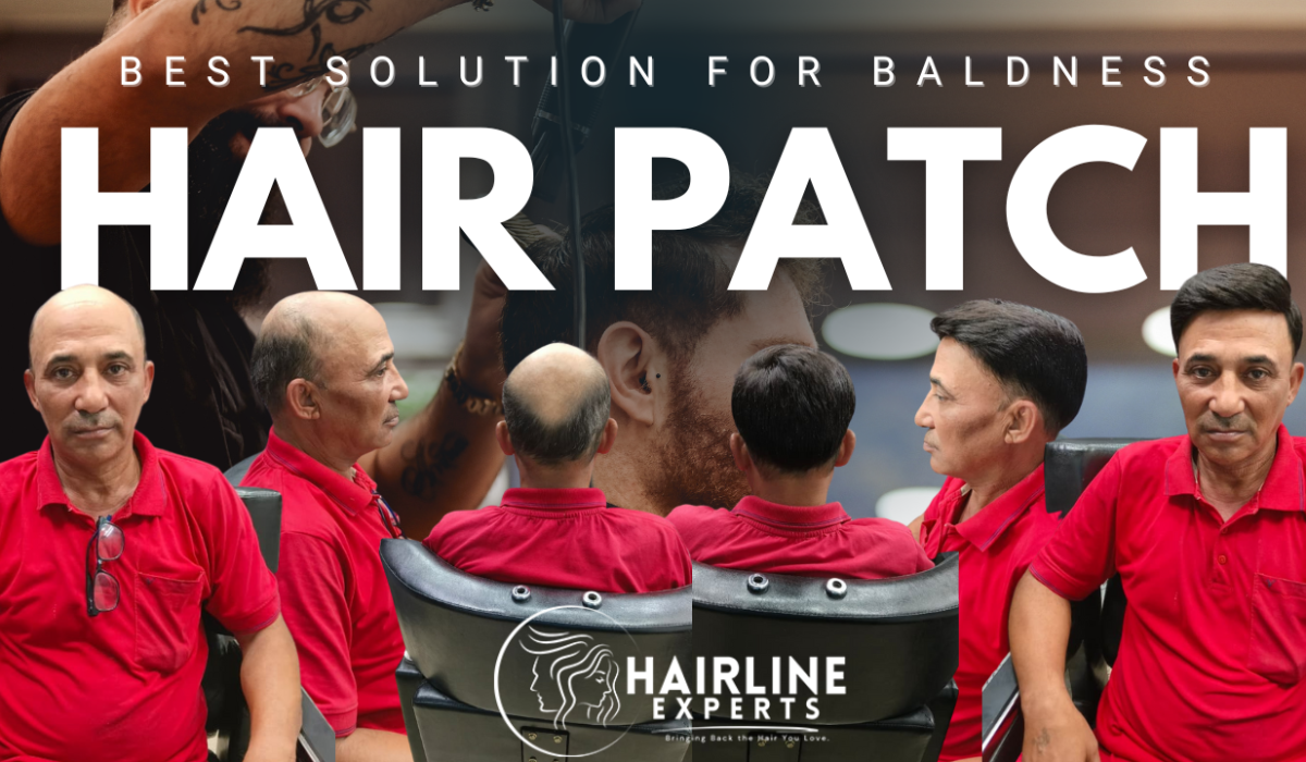 hairline-patch-thumb